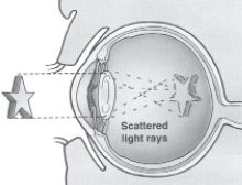 When the lens of your eye becomes cloudy, the eye cataract is preventing you from seeing clearly by blocking enough light from passing through.