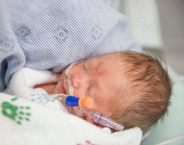 Retinopathy of Prematurity (ROP) Retinopathy of Prematurity (ROP)