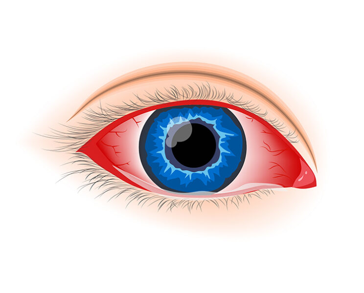 Viral Conjunctivitis (Pink Eye) Viral Conjunctivitis (Pink Eye)